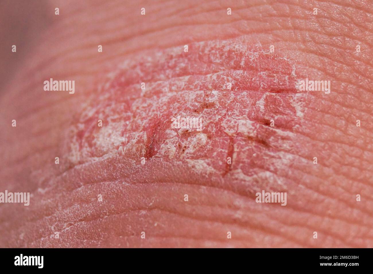 Irritation of the skin hi-res stock photography and images - Alamy