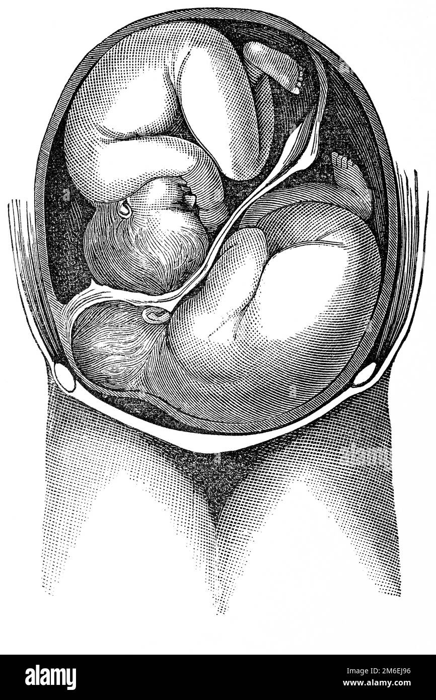 Twins. One of the fetuses presents vertex and the other trunk. Antique illustration from a medical book. 1889. Stock Photo