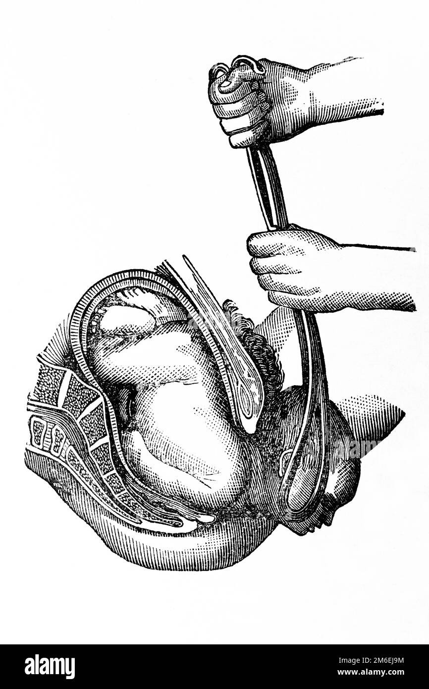 Helping birth. Last time of the extraction, extension of the head practiced with the forceps. Antique illustration from a medical book. 1889. Stock Photo