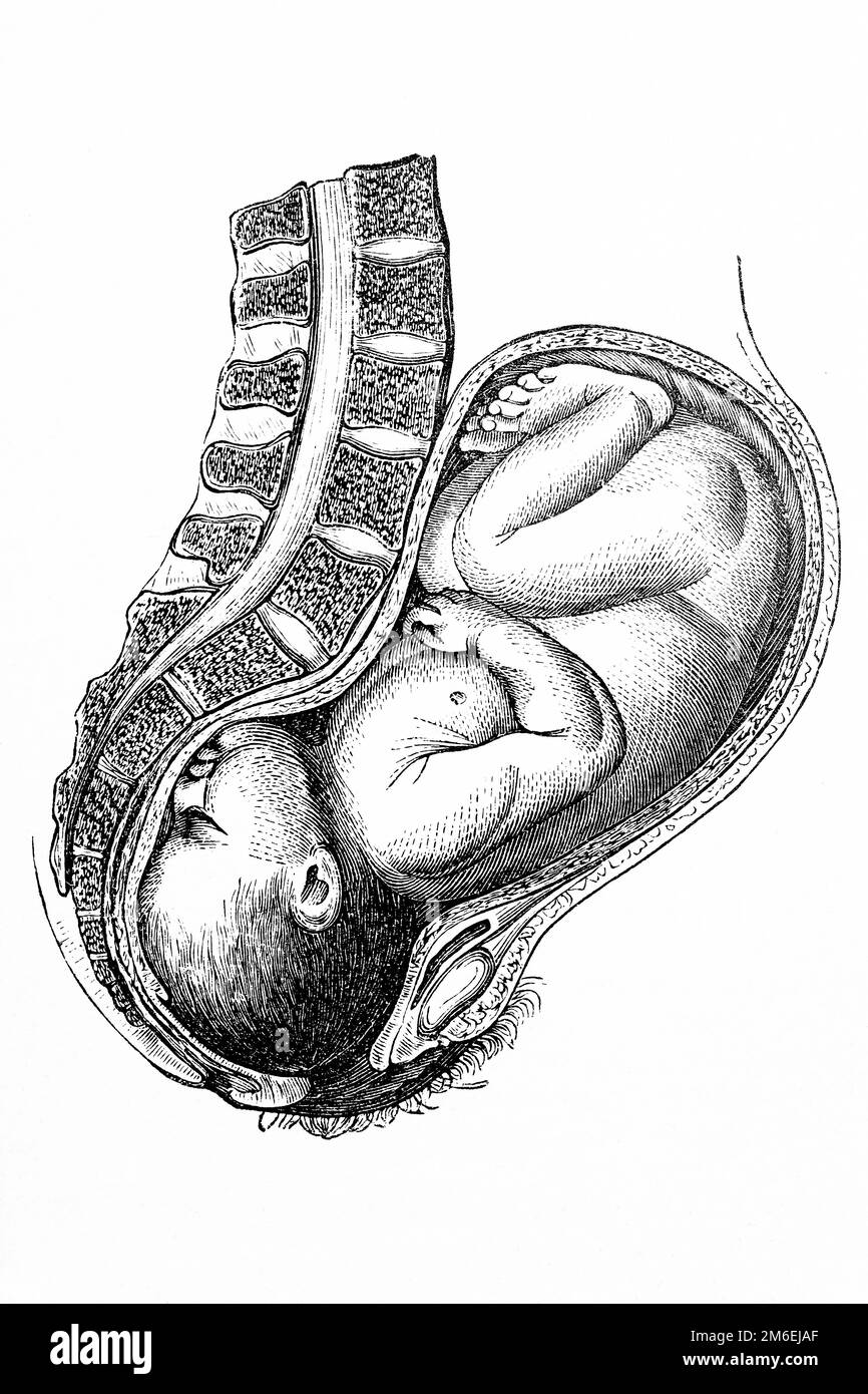 Next birth. The head is near to come out. Antique illustration from a medical book. 1889. Stock Photo