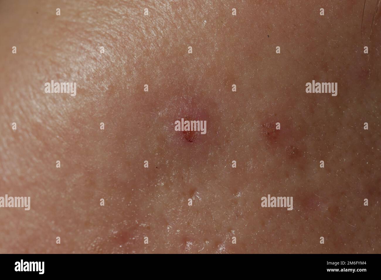 Extreme closeup of texture of problematic human skin with large