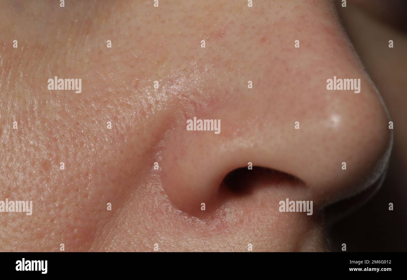 Extreme close-up of texture of problematic human skin with large-looking open pores, acne scars and nasolabial fold Stock Photo