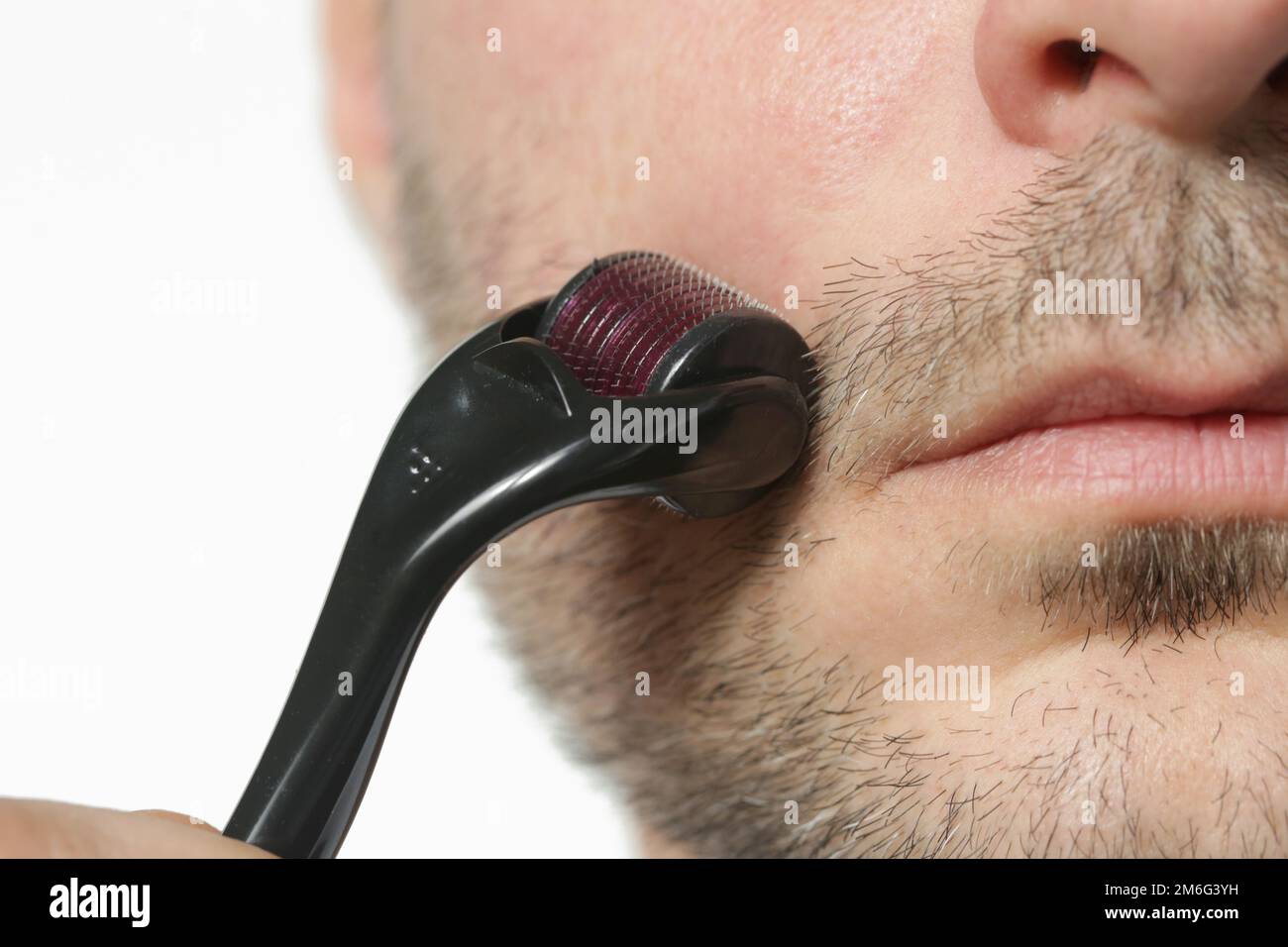Facial massage with microneedle dermaroller for the treatment of scars
