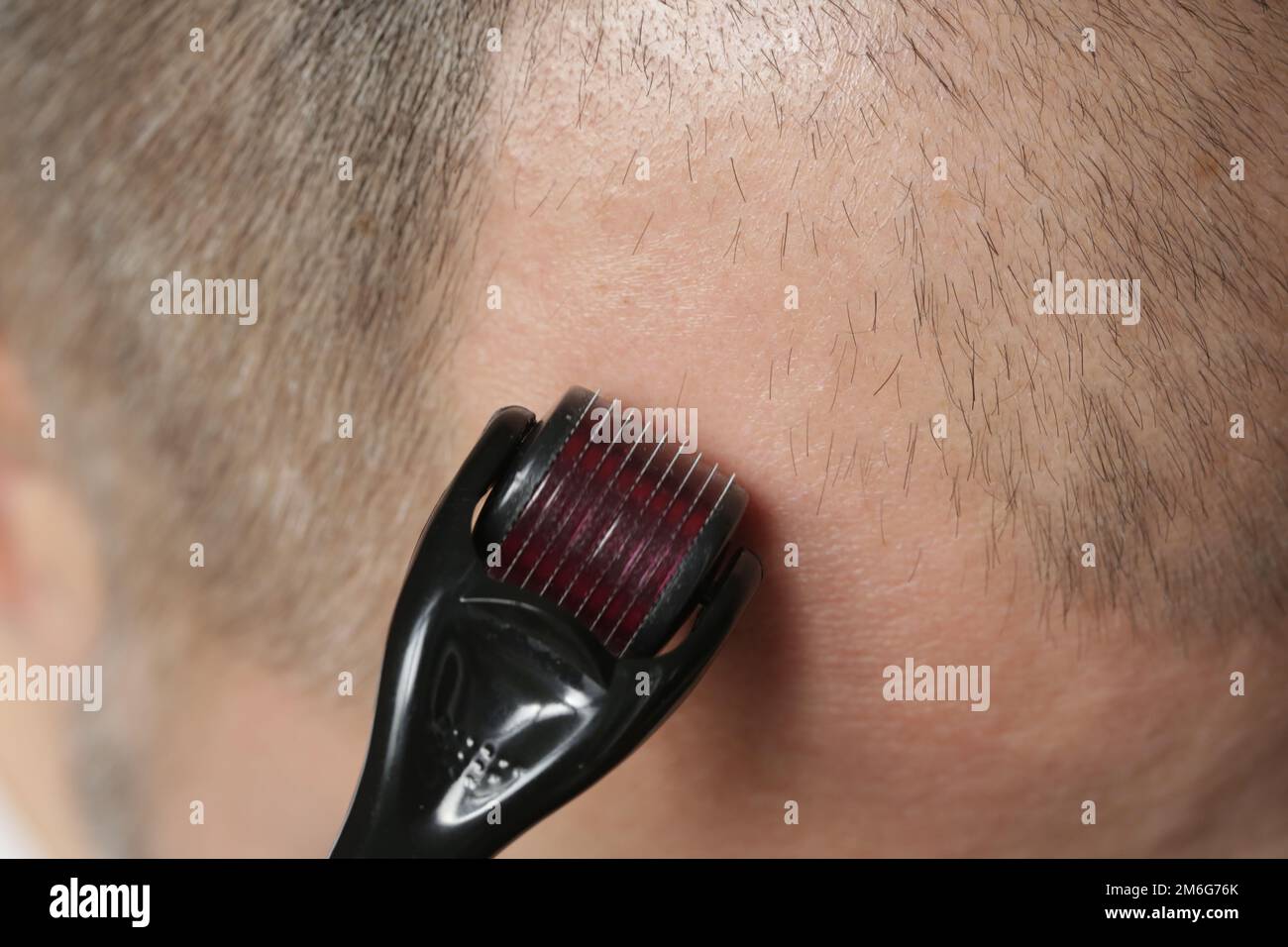 Men using microneedle derma roller on head for stimulating new hair growth. Simple and cheap treatment for alopecia. Stock Photo