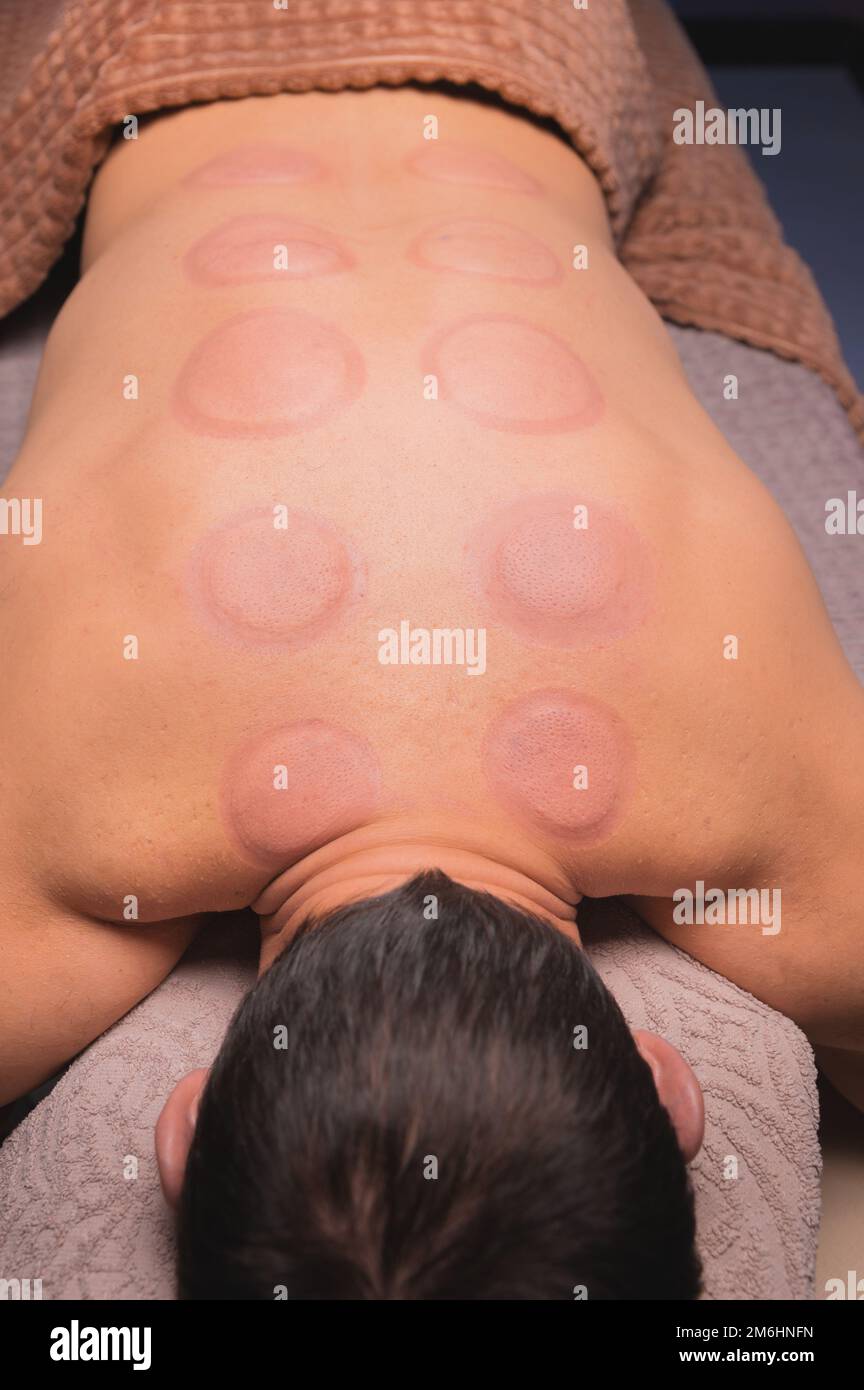 Man after cupping therapy on his back. Skin after cupping in traditional Chinese medicine. man returned from hijama cups in acup Stock Photo