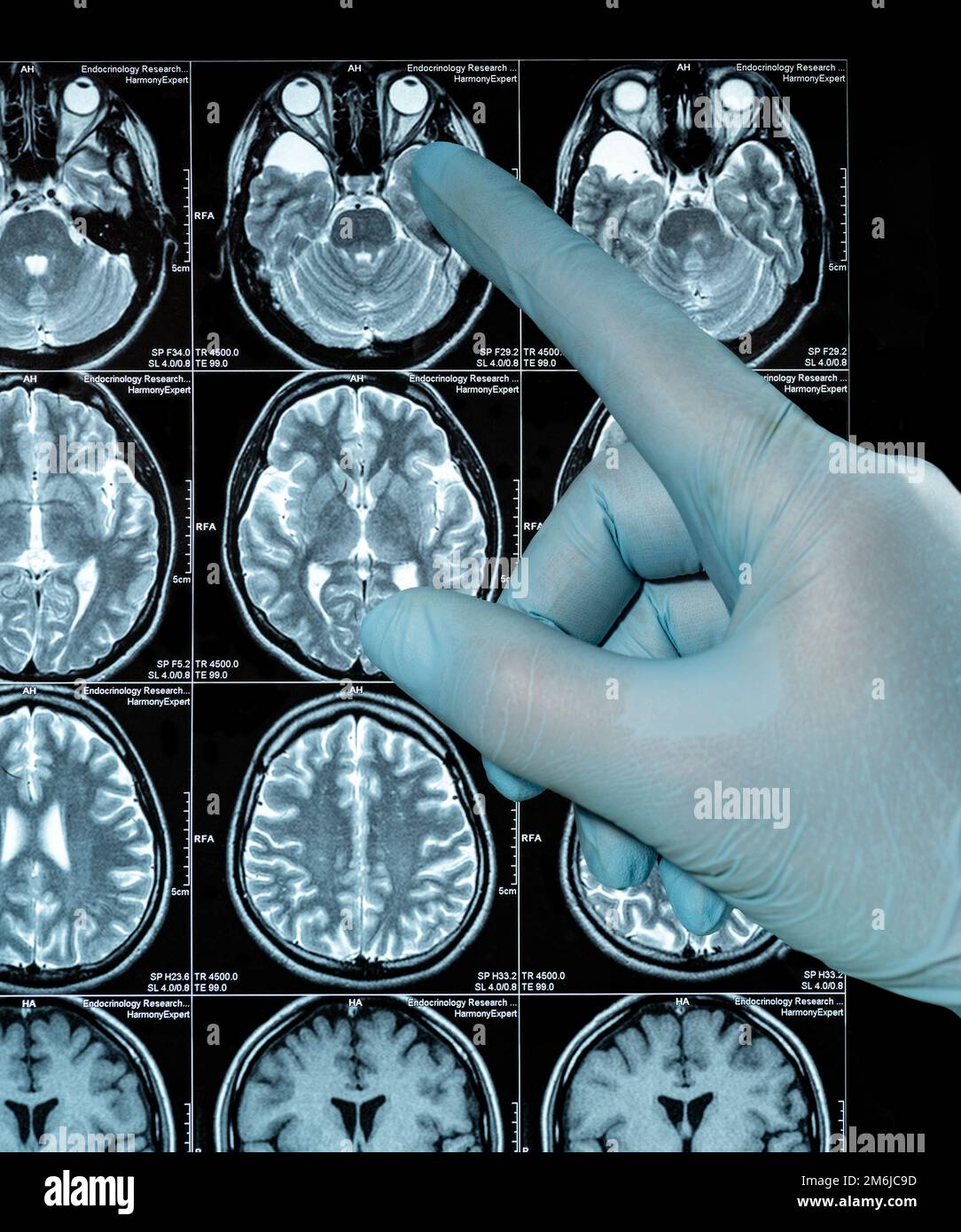 MRI Scan image of a human brain showing all main multiple sclerosis hand in glove points Stock Photo