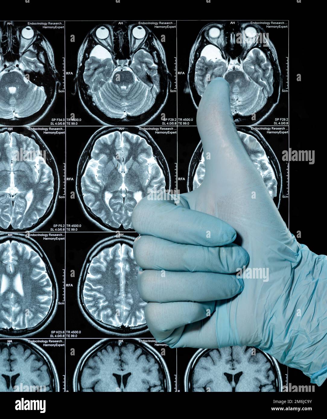 MRI Scan image of a human brain showing all main multiple sclerosis hand in glove thumbs up Stock Photo