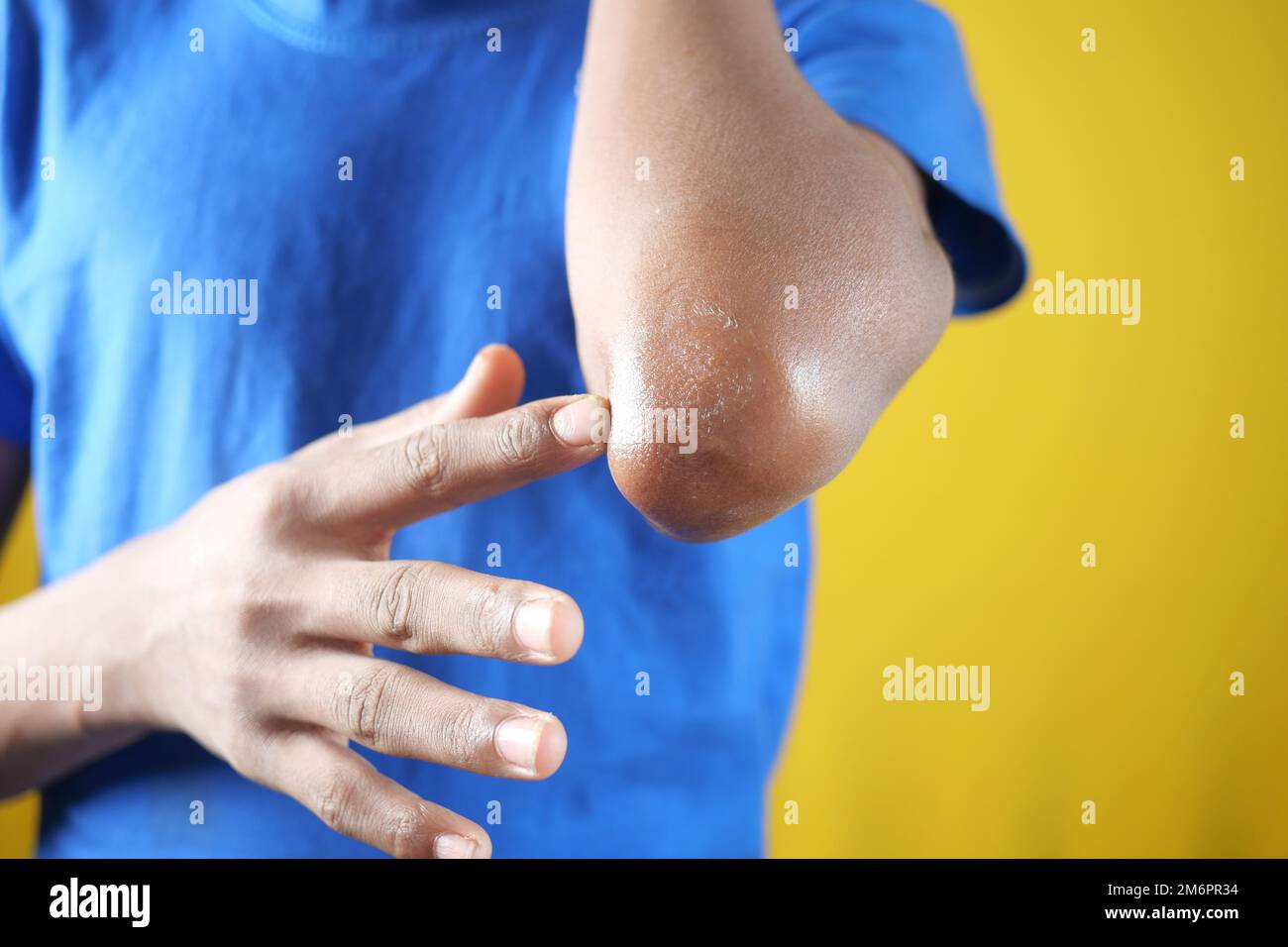 men applying petroleum jelly on elbow  Stock Photo
