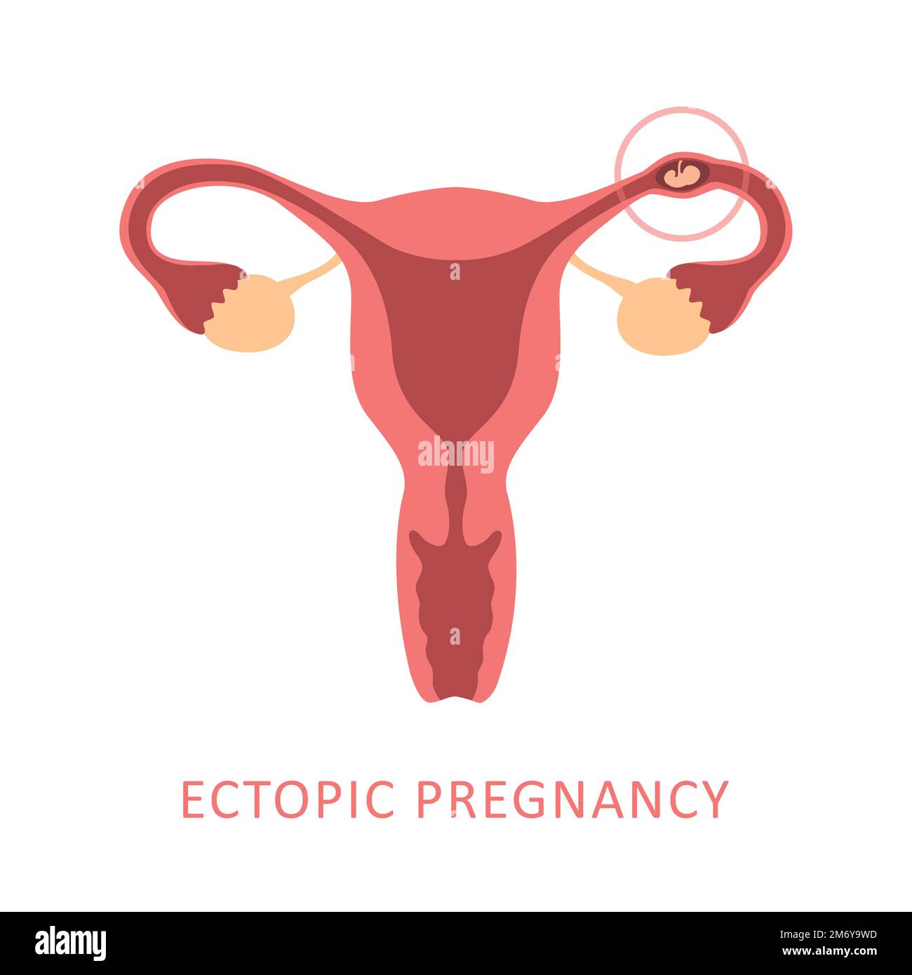 ectopic pregnancy female reproductive system women uterus Stock Vector