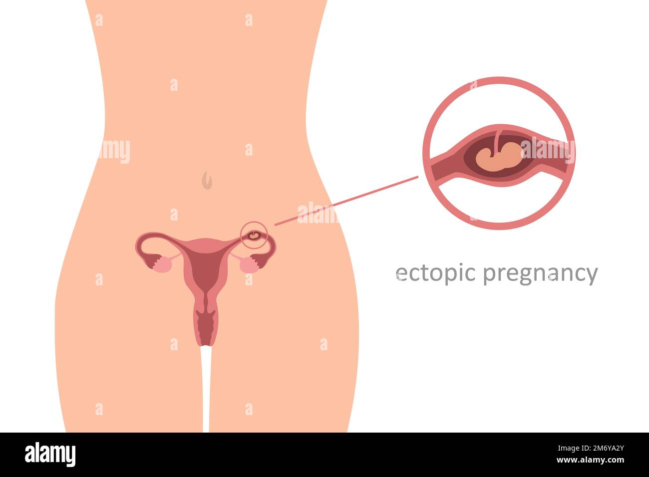 ectopic pregnancy info graphic womens health embryo Stock Vector