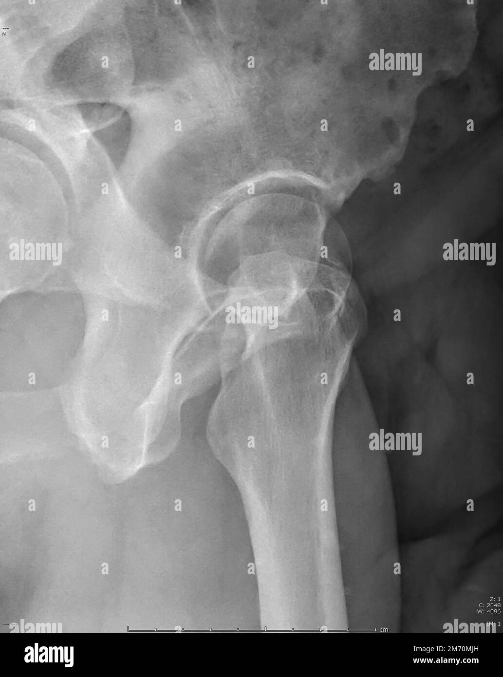 x-ray of a femur and part of pelvis, hop of male body in the 50s Stock Photo