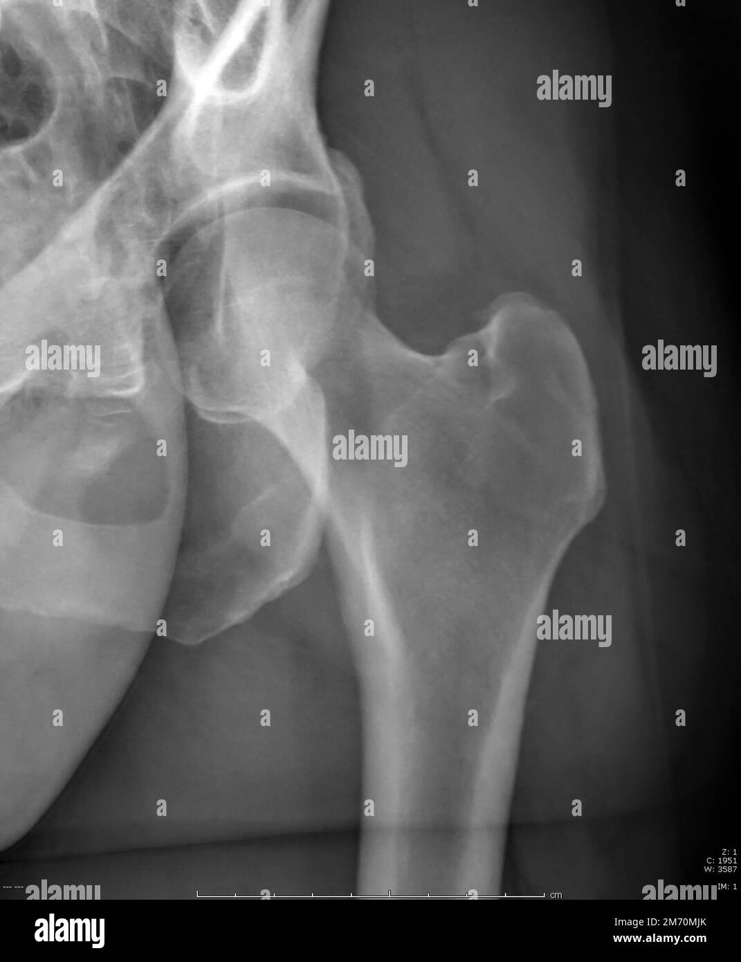 x-ray of a femur and part of pelvis, hop of male body in the 50s Stock Photo