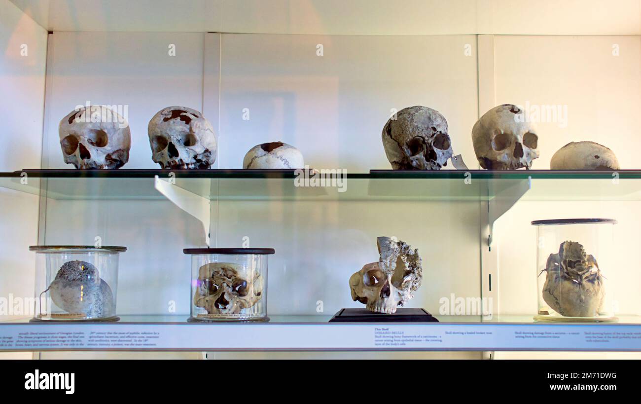 THE HUNTERIAN MEDICINE AND ANATOMY OOLLECTION/ a selection of  medically interesting indigenous human skulls Stock Photo