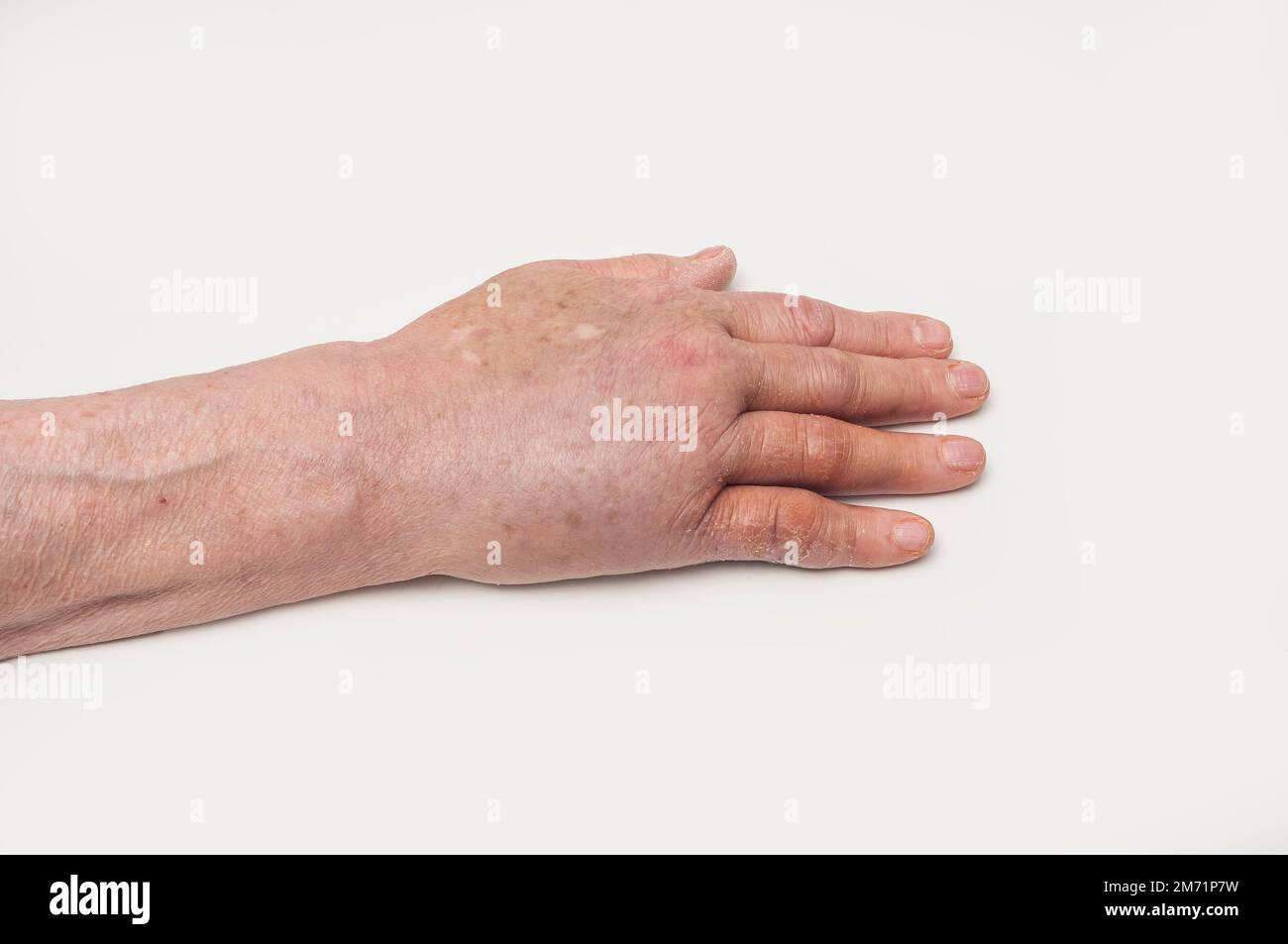 Top of PostOperative Swollen Dupuytren's Contracture Right Hand Stock