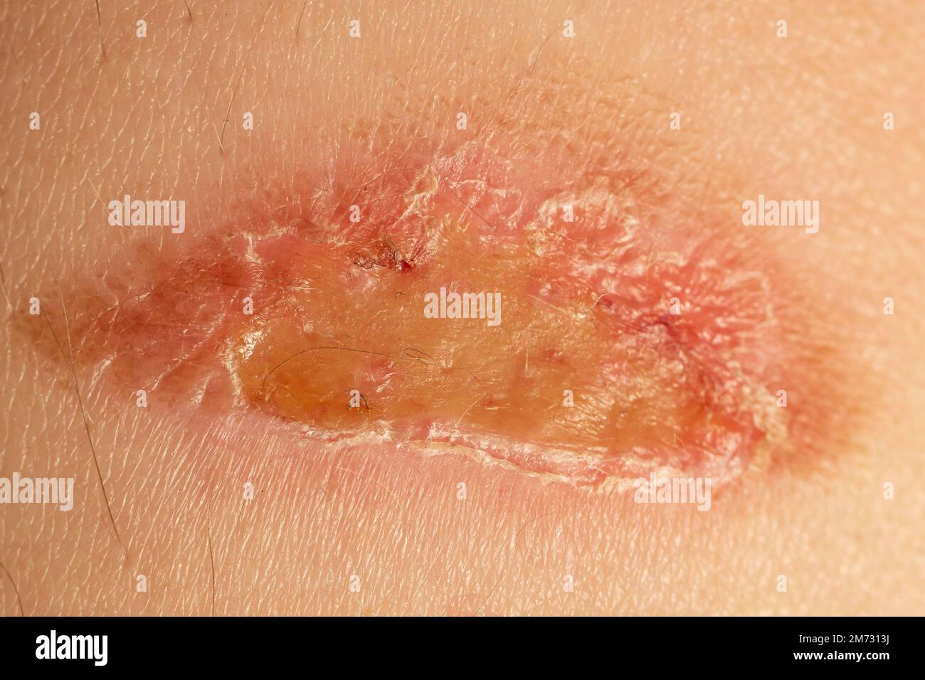 burn wound on skin texture, soft focus extreme macro Stock Photo