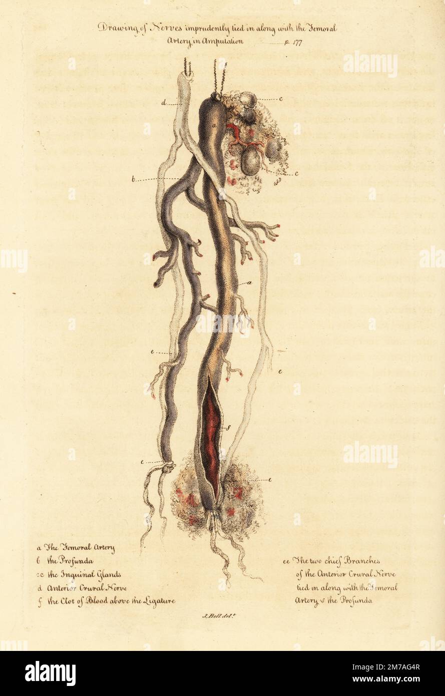 Example of Claude Pouteau's doctrine of tying nerves to arteries in amputations. Drawing of nerves imprudently tied in along with the Femoral Artery in Amputation. Femoral artery a, profunda b, inguinal glands cc, anterior crural nerve d, two chief branches of the anterior crural nerve tied in ee, and clot of blood above the ligature f. Handcoloured copperplate engraving after an illustration by John Bell from his own Principles of Surgery, as they Relate to Wounds, Ulcers and Fistulas, Longman,  Hurst, Rees, Orme and Brown, London, 1815. Stock Photo