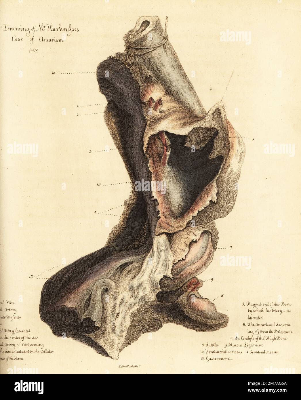 Fatal aneurysmal sac from the broken leg of a man, 1815. The sailor died of gangrene before the leg could be amputated. Drawing of Mr. Harkness's case of aneurism. Femoral vein 1, femoral artery 2, lacerated femoral artery 3, popliteal artery 4, ragged end of the bone 5, aneurysmal sac 6, condyle of the thigh bone 7, putella 8, mucous ligament 9, semimembranosus 10, semilendinosus 11, gastroenemii 12. Handcoloured copperplate engraving by after an illustration by John Bell from his own Principles of Surgery, as they Relate to Wounds, Ulcers and Fistulas, Longman,  Hurst, Rees, Orme and Brown, Stock Photo