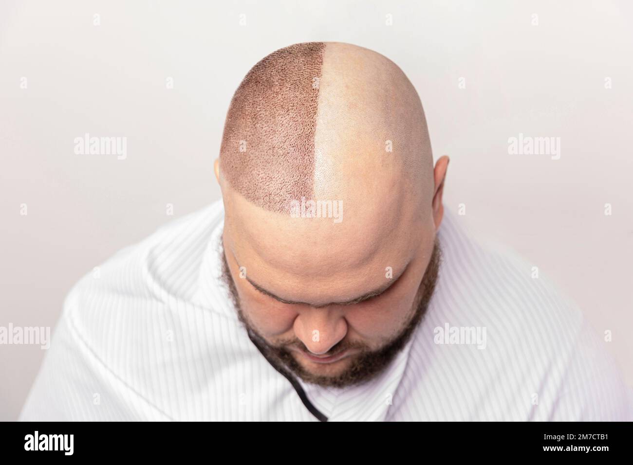 male baldness before and after treatment. portrait of a man with baldness problem at a hair transplant operation. Cosmetic surgery. the process of hai Stock Photo