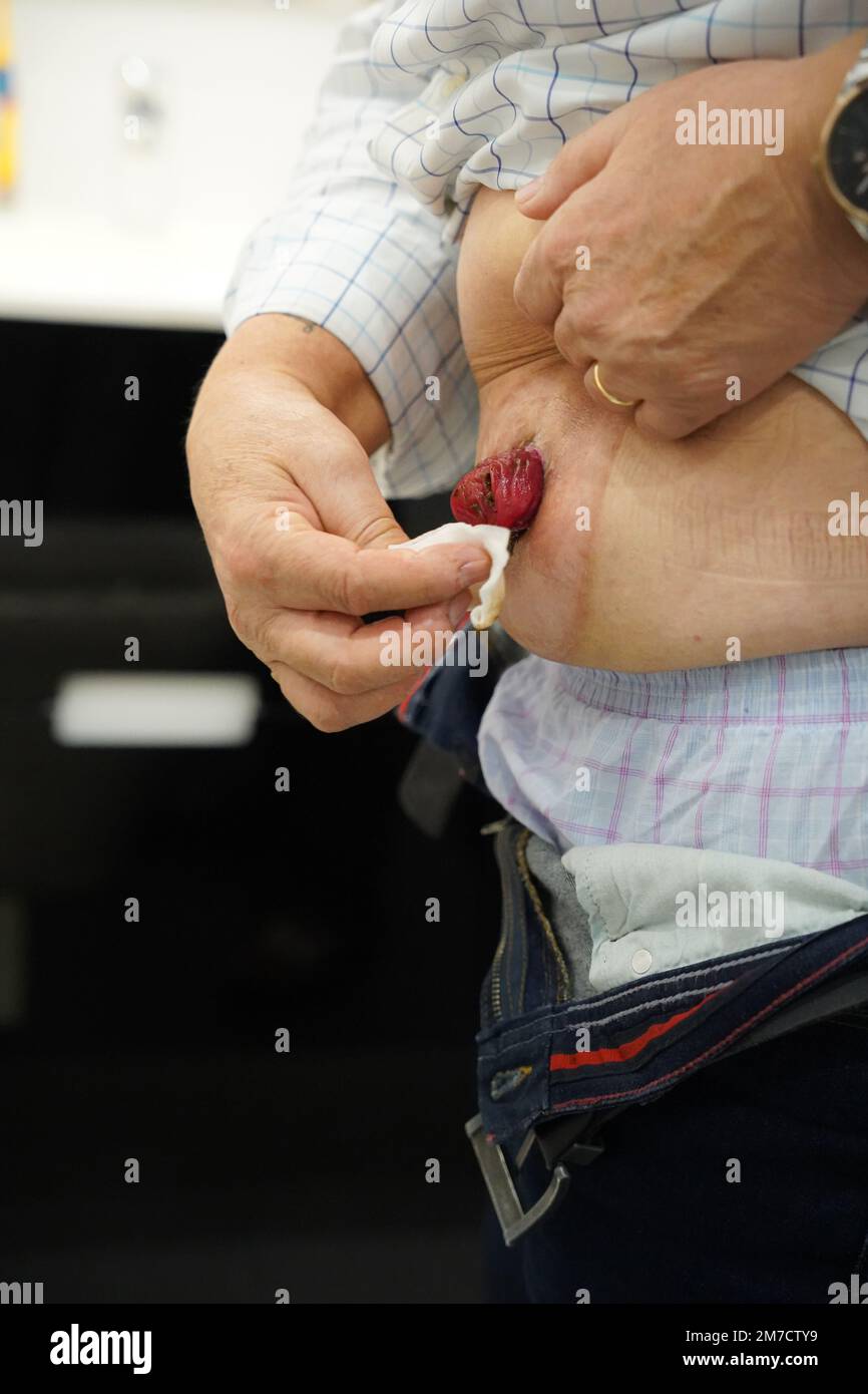 Mature man with stoma wearing transparent ileostomy bag. See image 2ARGPBT  for new, empty bag after changing Stock Photo - Alamy