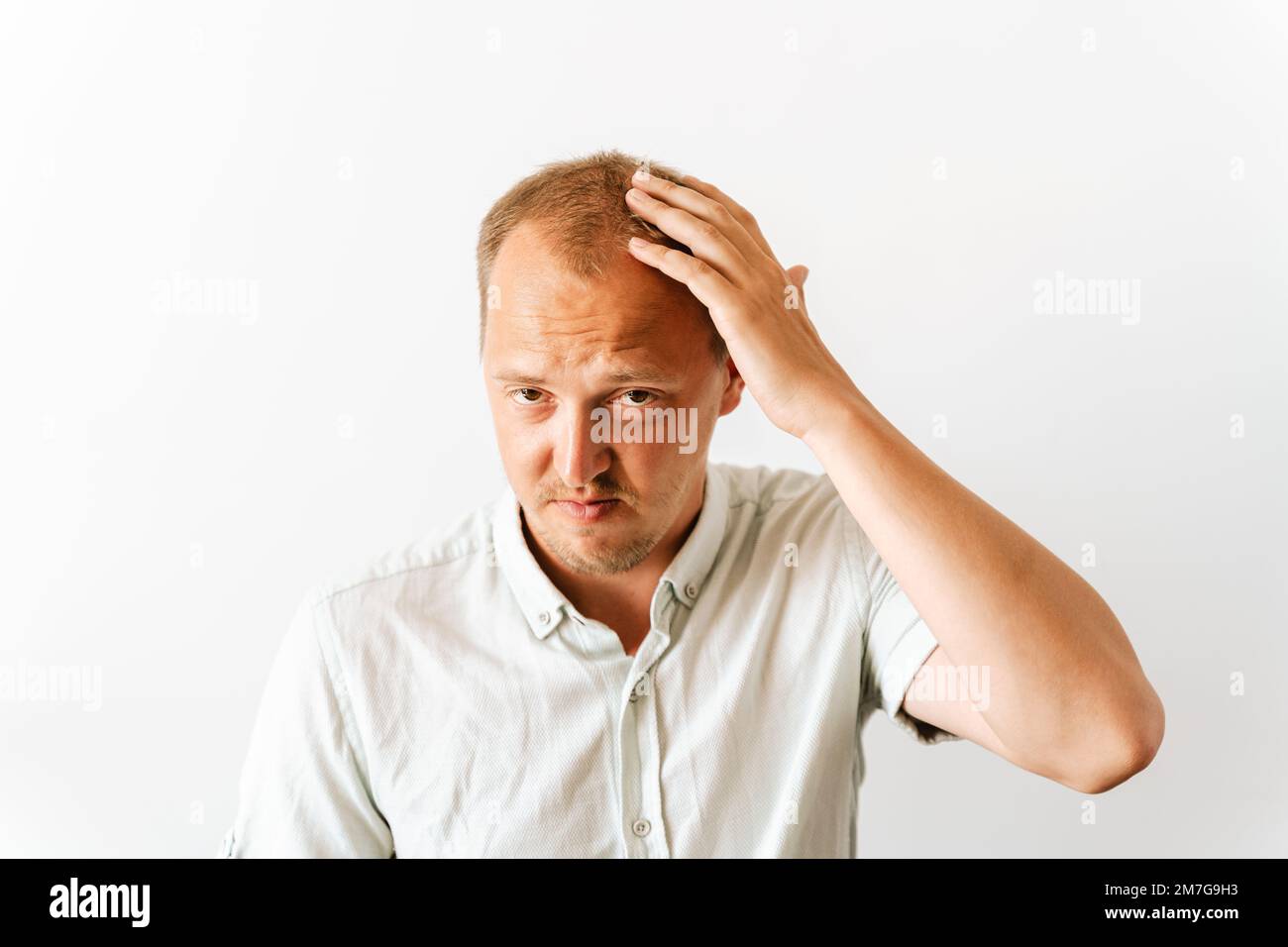 Before hair transplantation. Young sad bald man with depression at hair loss problems looking angry and frustrated and holding his head Stock Photo
