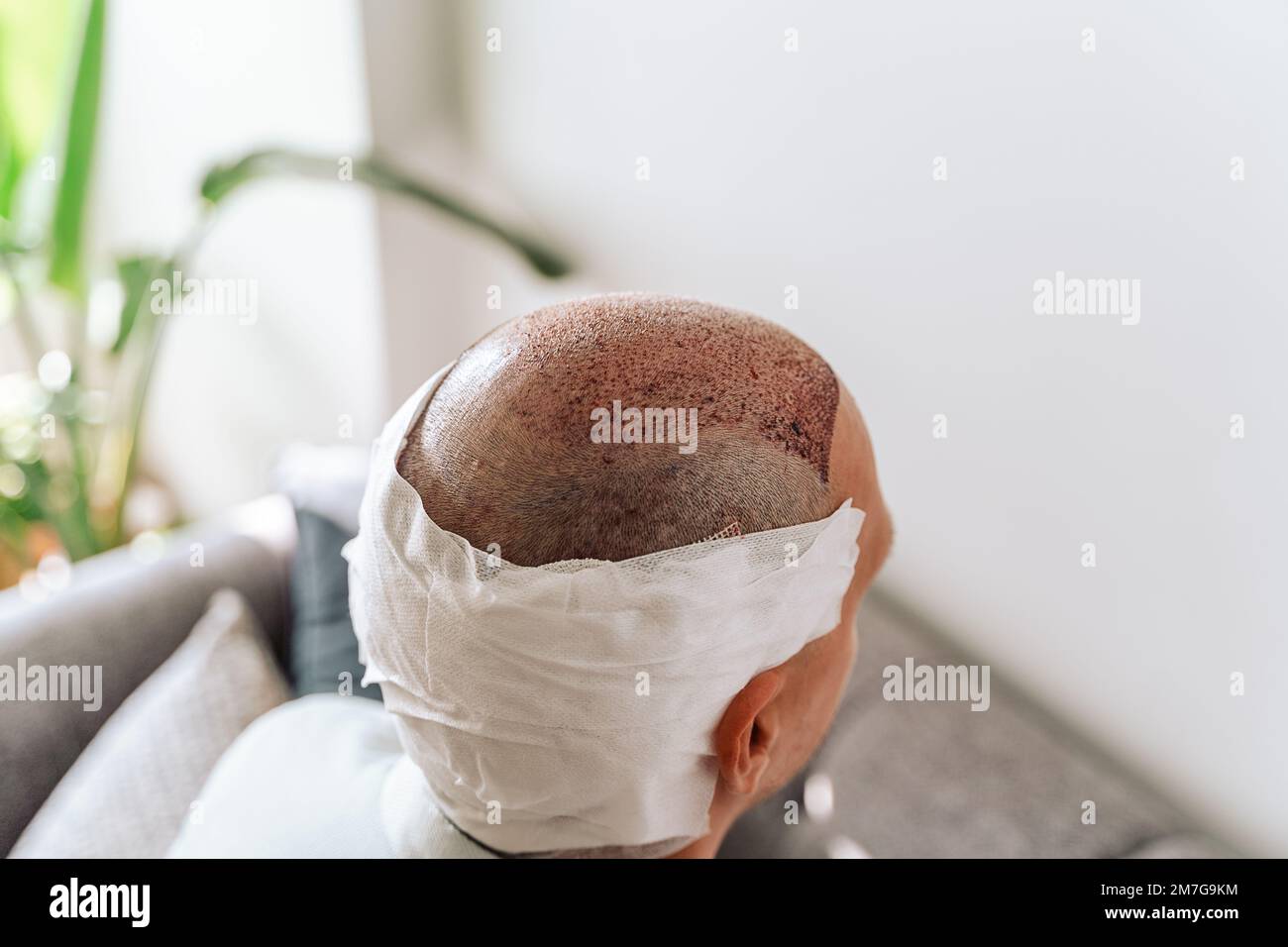 After hair transplantation surgical technique that moves hair follicles