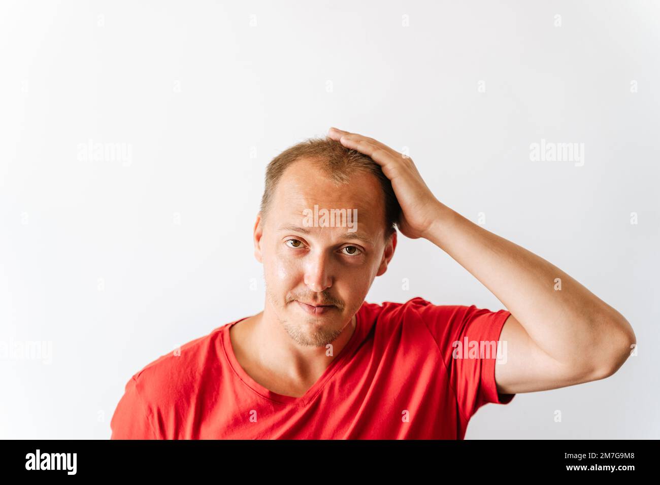 Before hair transplantation. Young bald man with hair loss problems holding his head Stock Photo