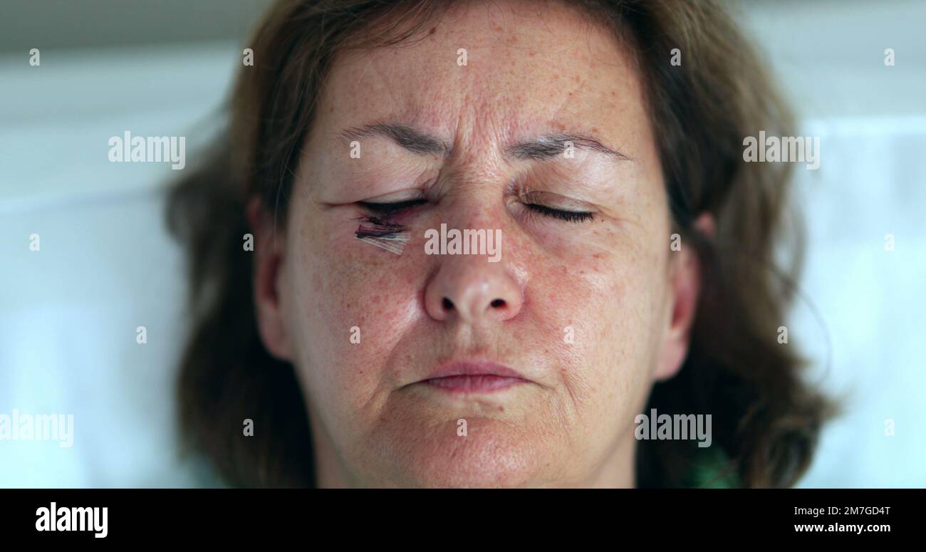 Older woman with bruise scar face opening eyes looking to camera Stock