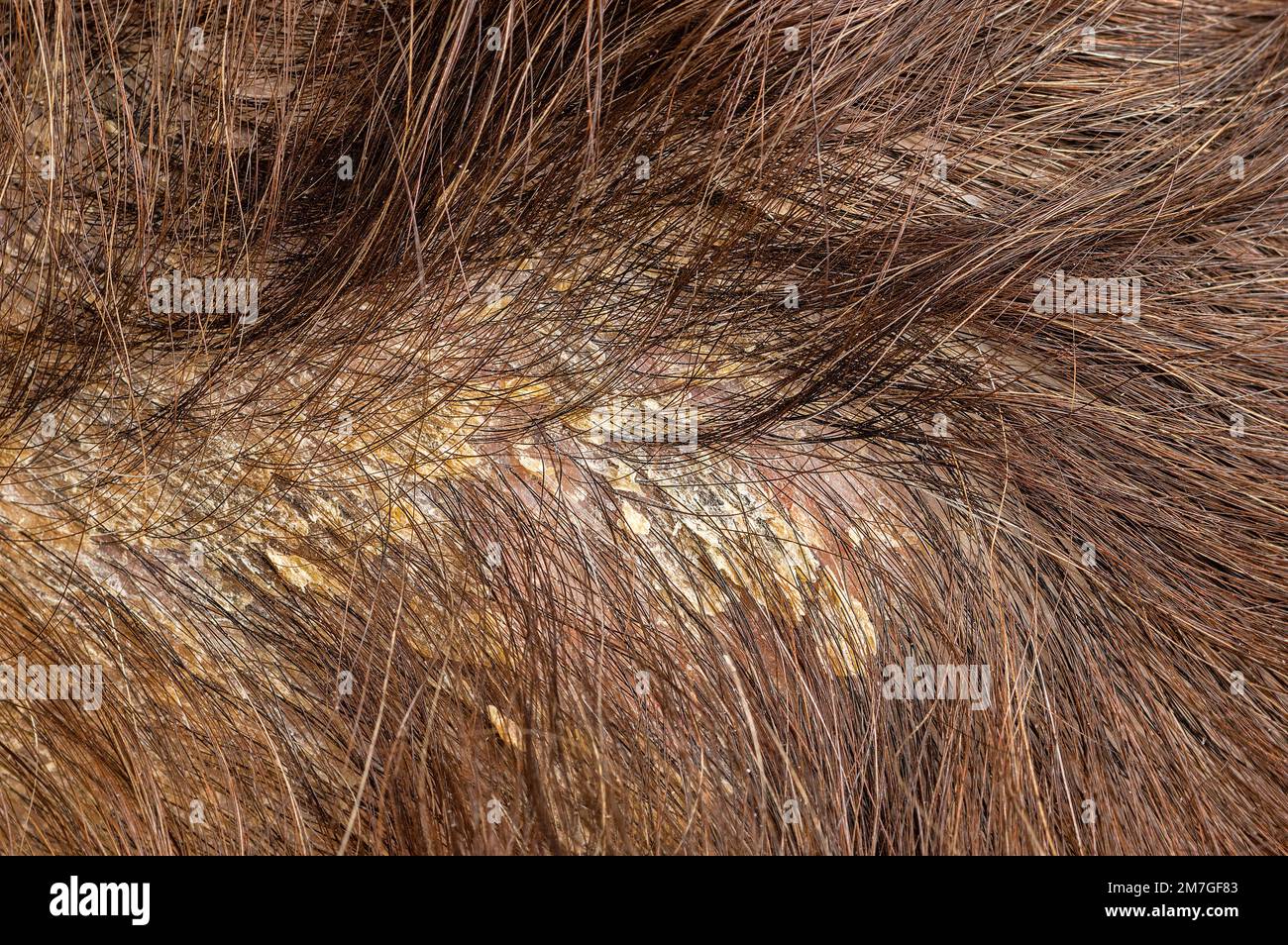 Psoriasis issue hi-res stock photography and images - Alamy