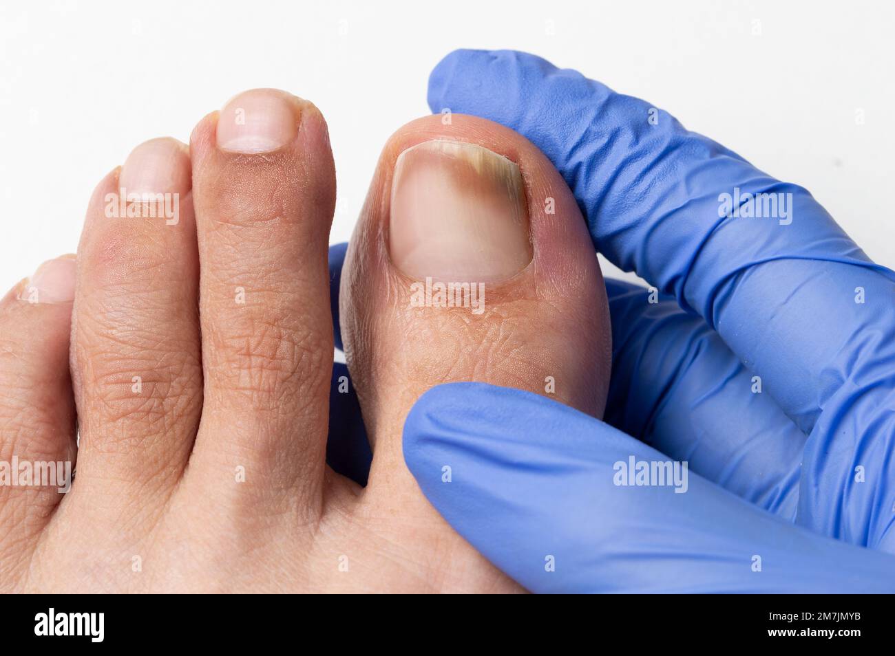 Close-up image of the doctor who controls the left toe that suffers a fungus nail Stock Photo