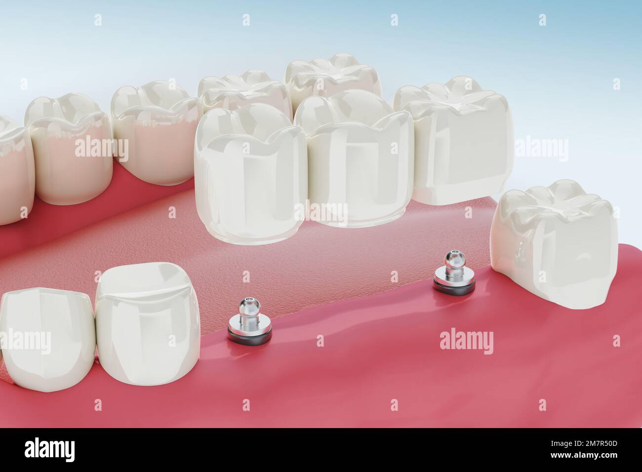 3drendering, abutment, antibiotic, artificial, beauty, care, cavity