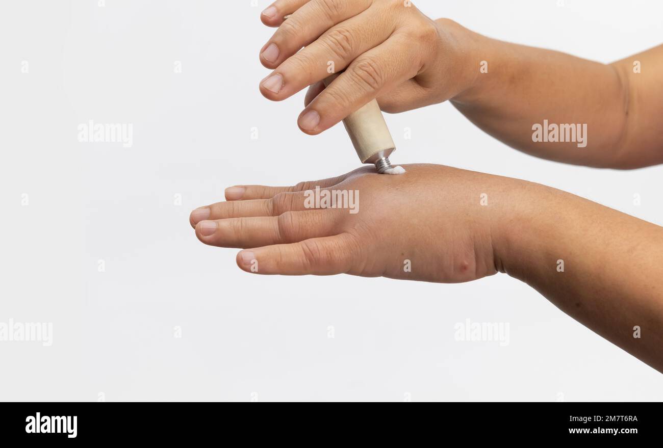 Woman apply a cream on swollen hand from allergic of insect stings