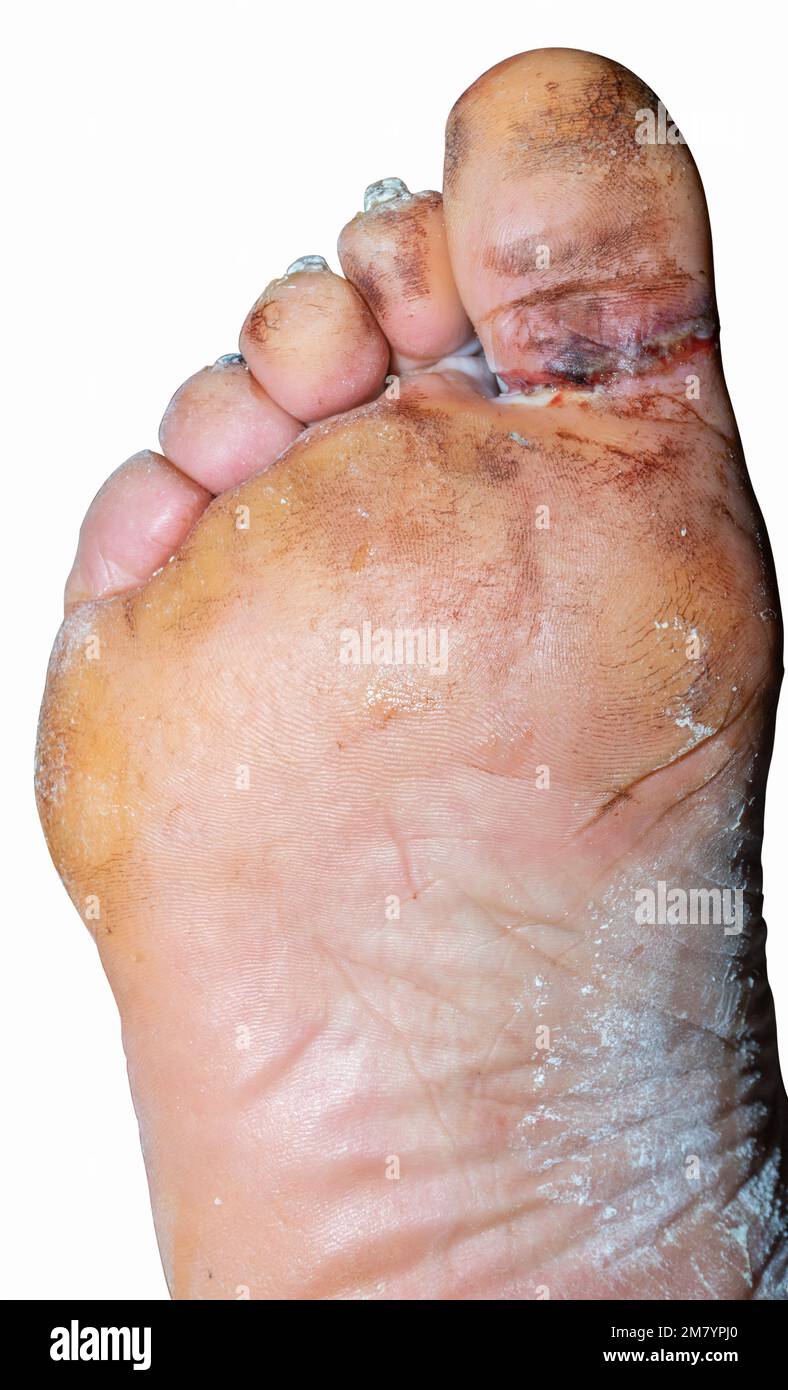A large laceration between the big toe and the foot Stock Photo