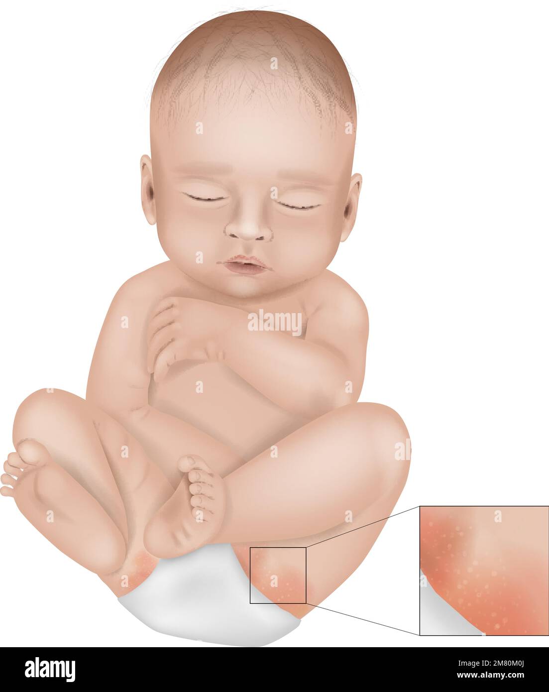 Diaper Rash or Irritant Diaper Dermatitis. Inflammation of the skin ...