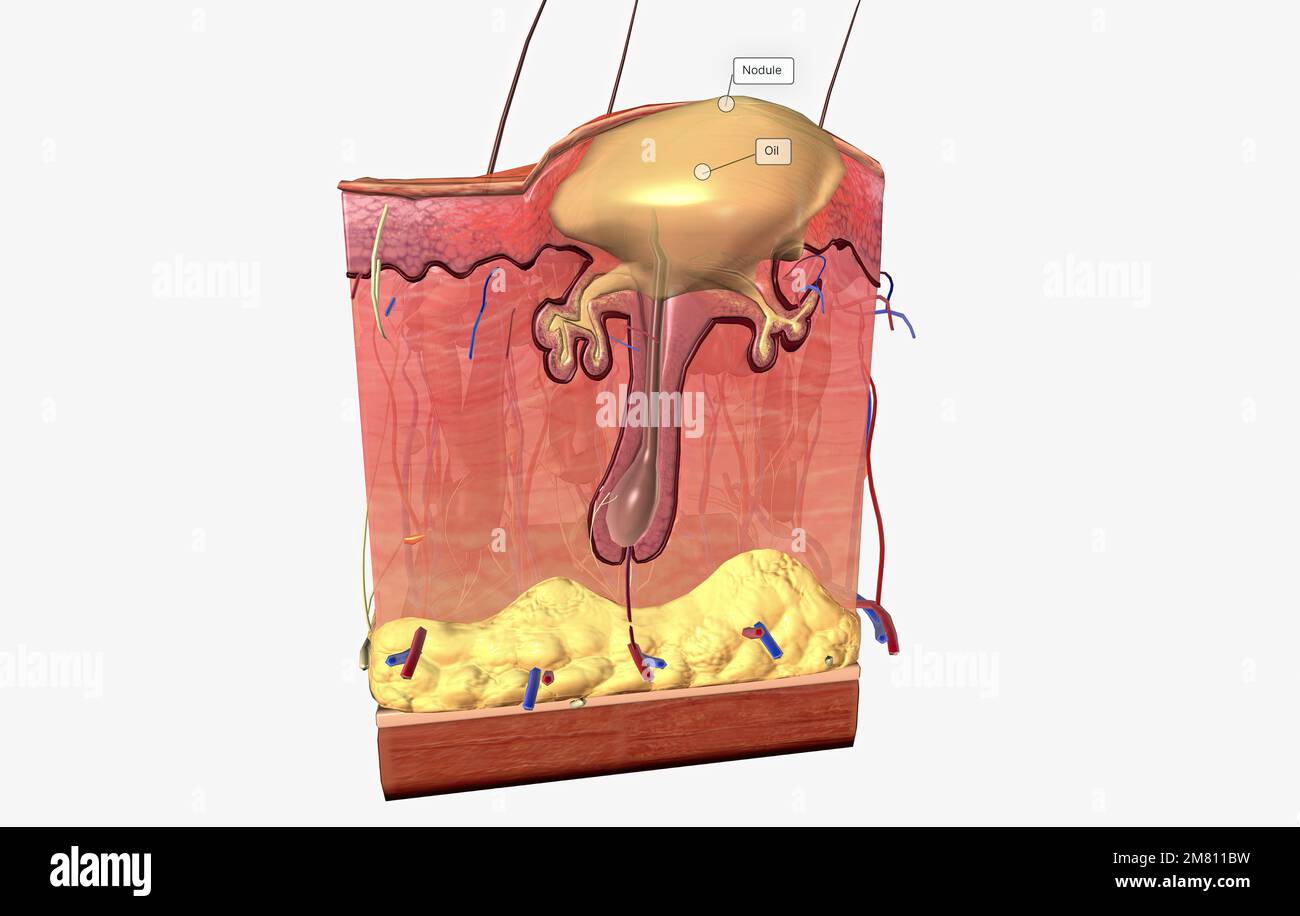 Acne is caused by a combination of factors acting on sebaceous (oil