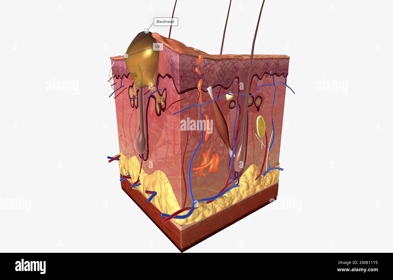 Acne is caused by a combination of factors acting on sebaceous (oil