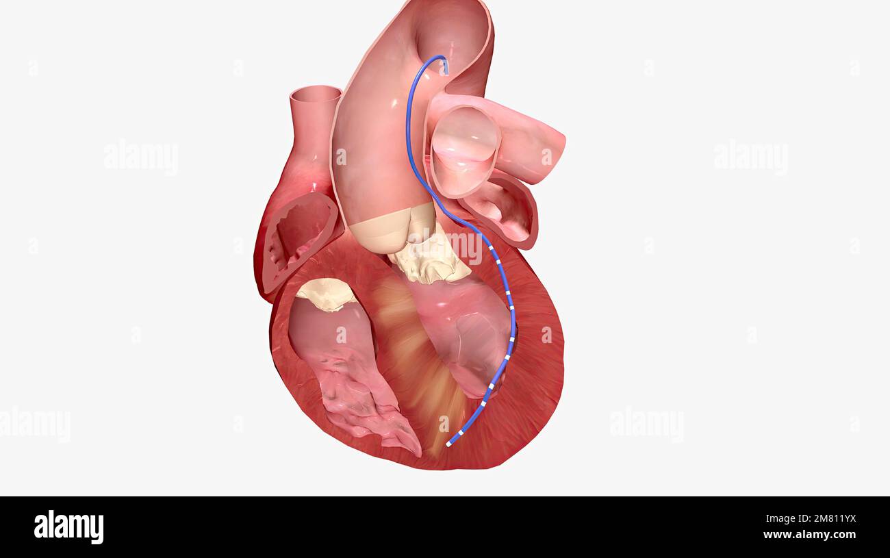 Alcohol causes enlarged heart muscle walls to shrink 3D rendering Stock