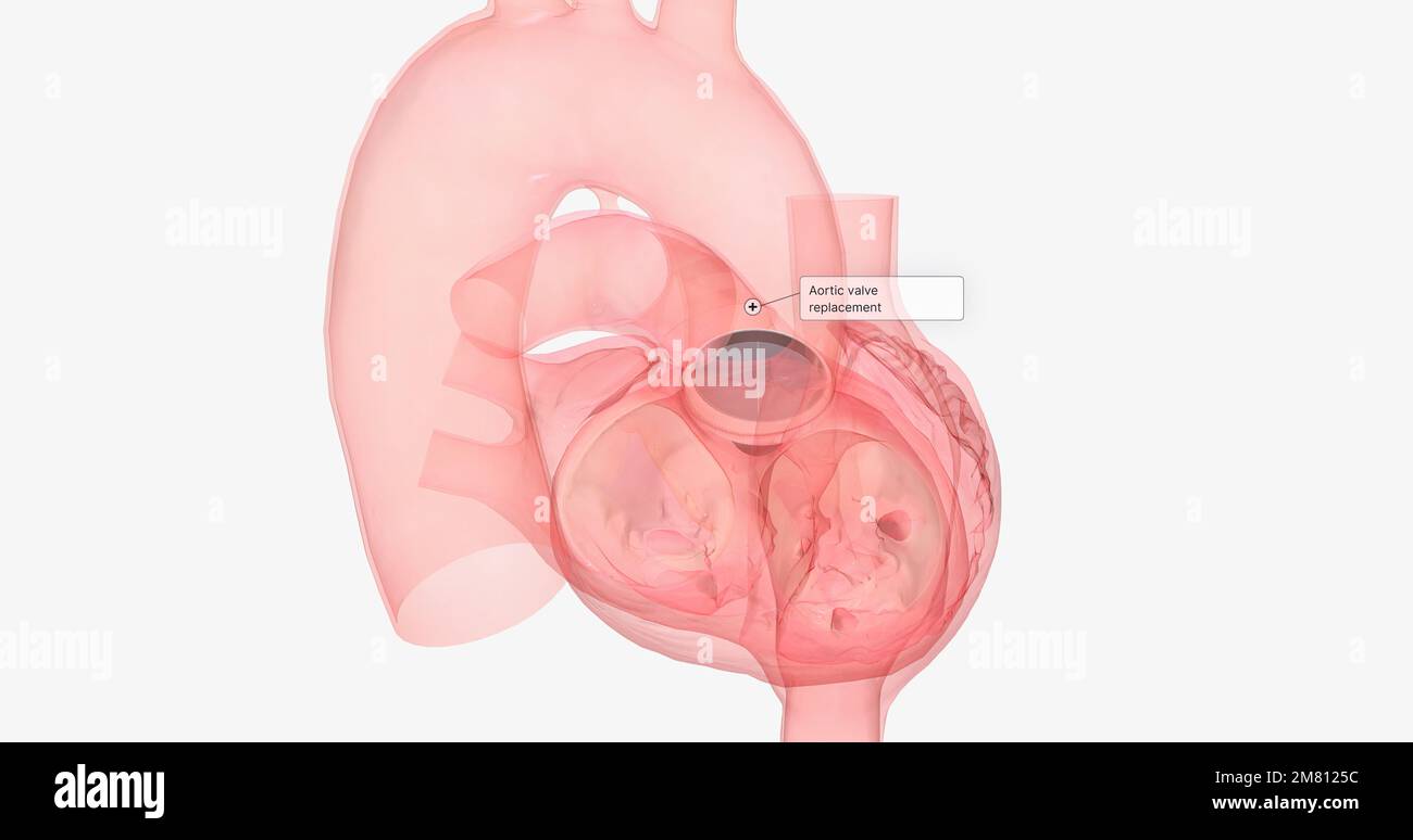 Damaged aortic heart valve hi-res stock photography and images - Alamy