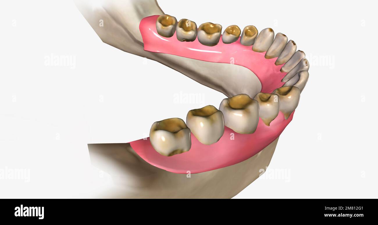 Dental erosion, also known as tooth erosion 3D rendering Stock Photo