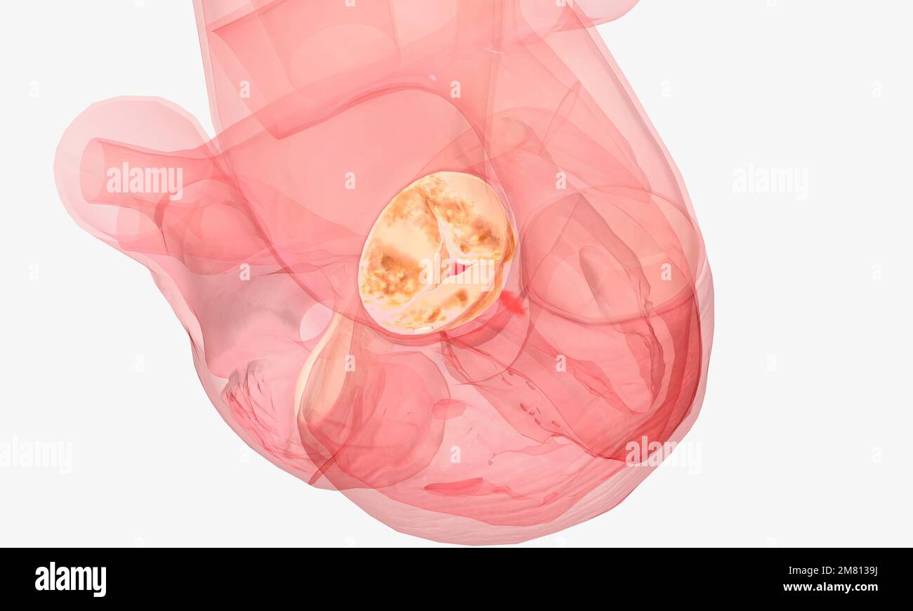 Damaged aortic heart valve hires stock photography and images Alamy