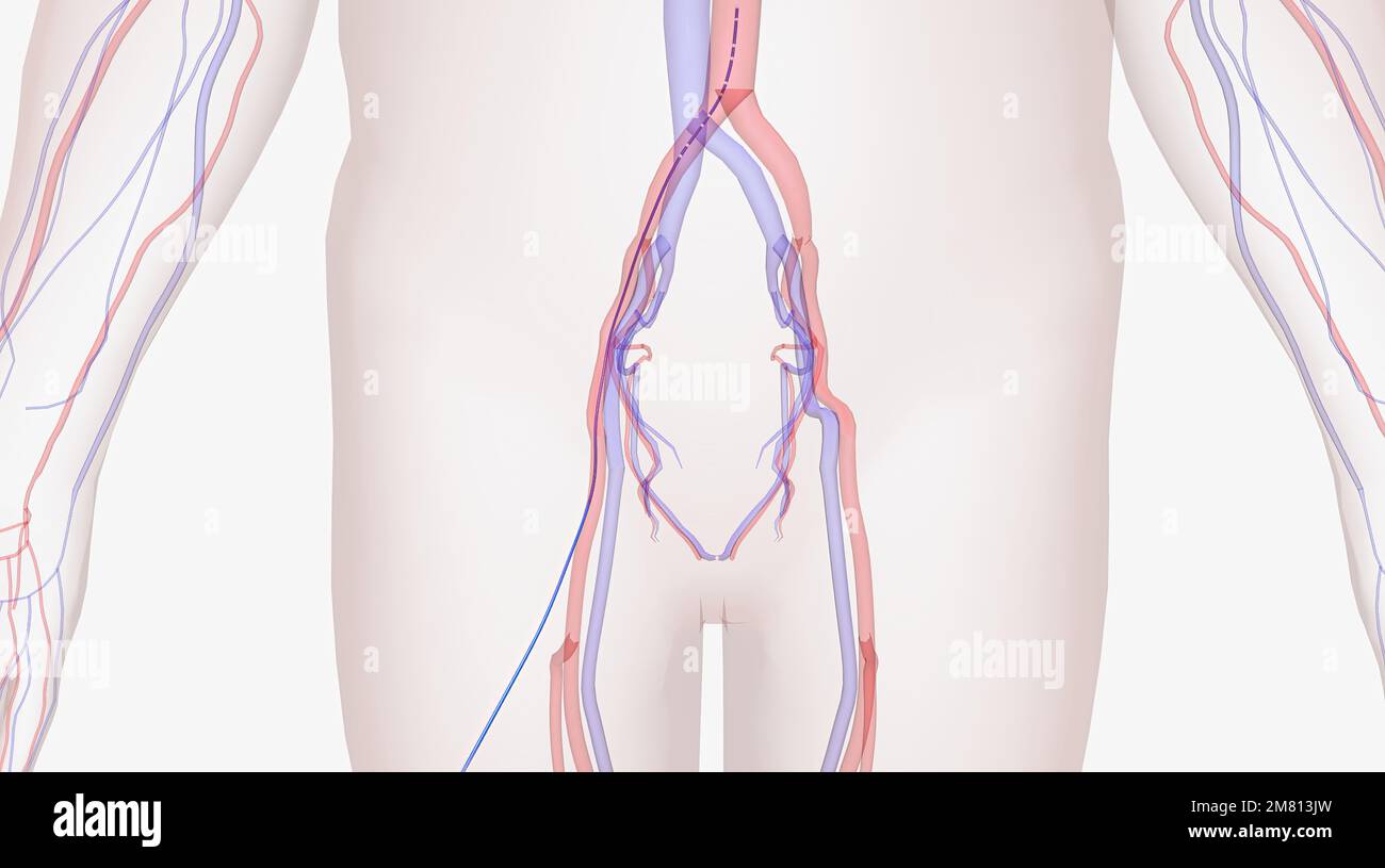 Using a local anesthetic, a catheter is inserted into a vein or artery