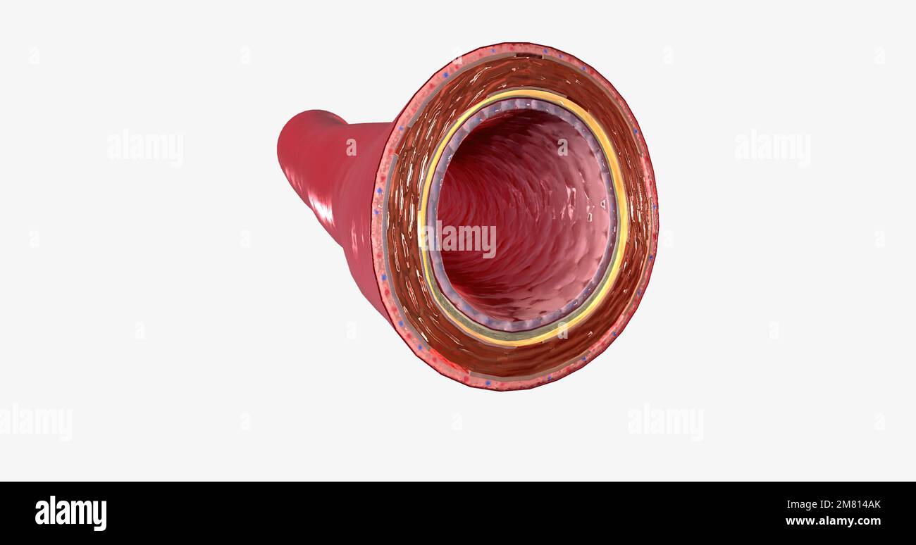 The walls of an artery consist of three layers.The tunica intima, the