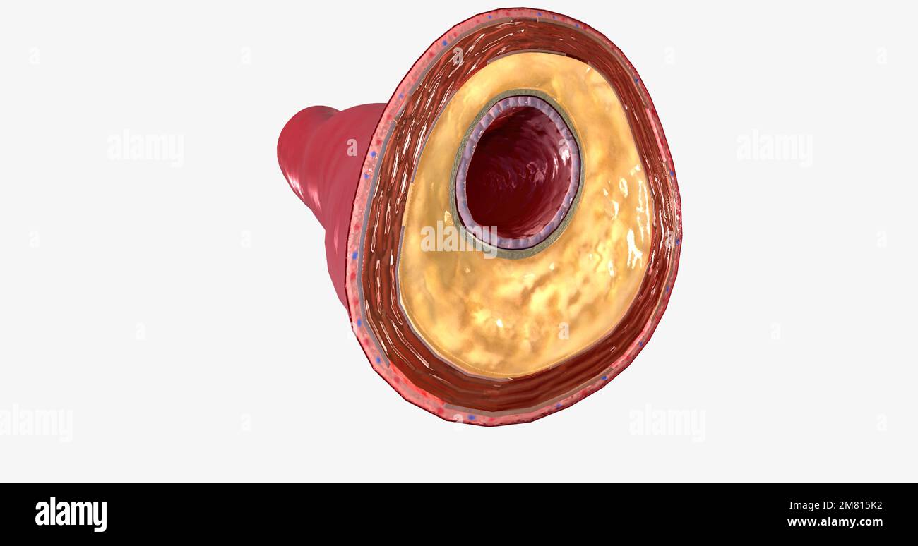 Plaque arterial wall hires stock photography and images Alamy
