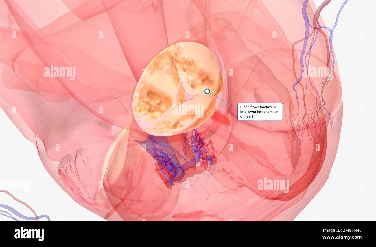Damaged aortic heart valve hires stock photography and images Alamy
