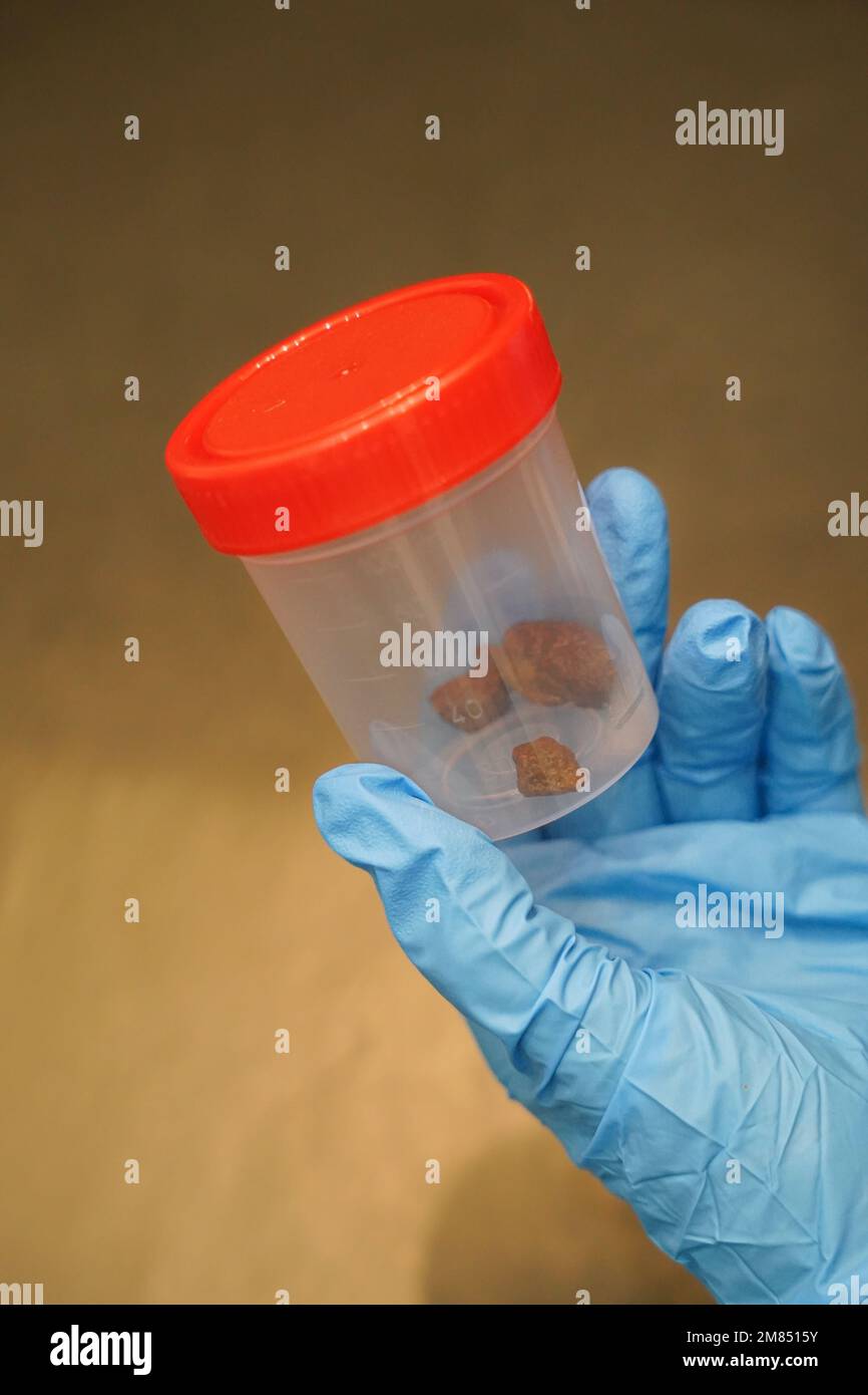 hands in nurse gloves collect a sample of stool for analysis. stool