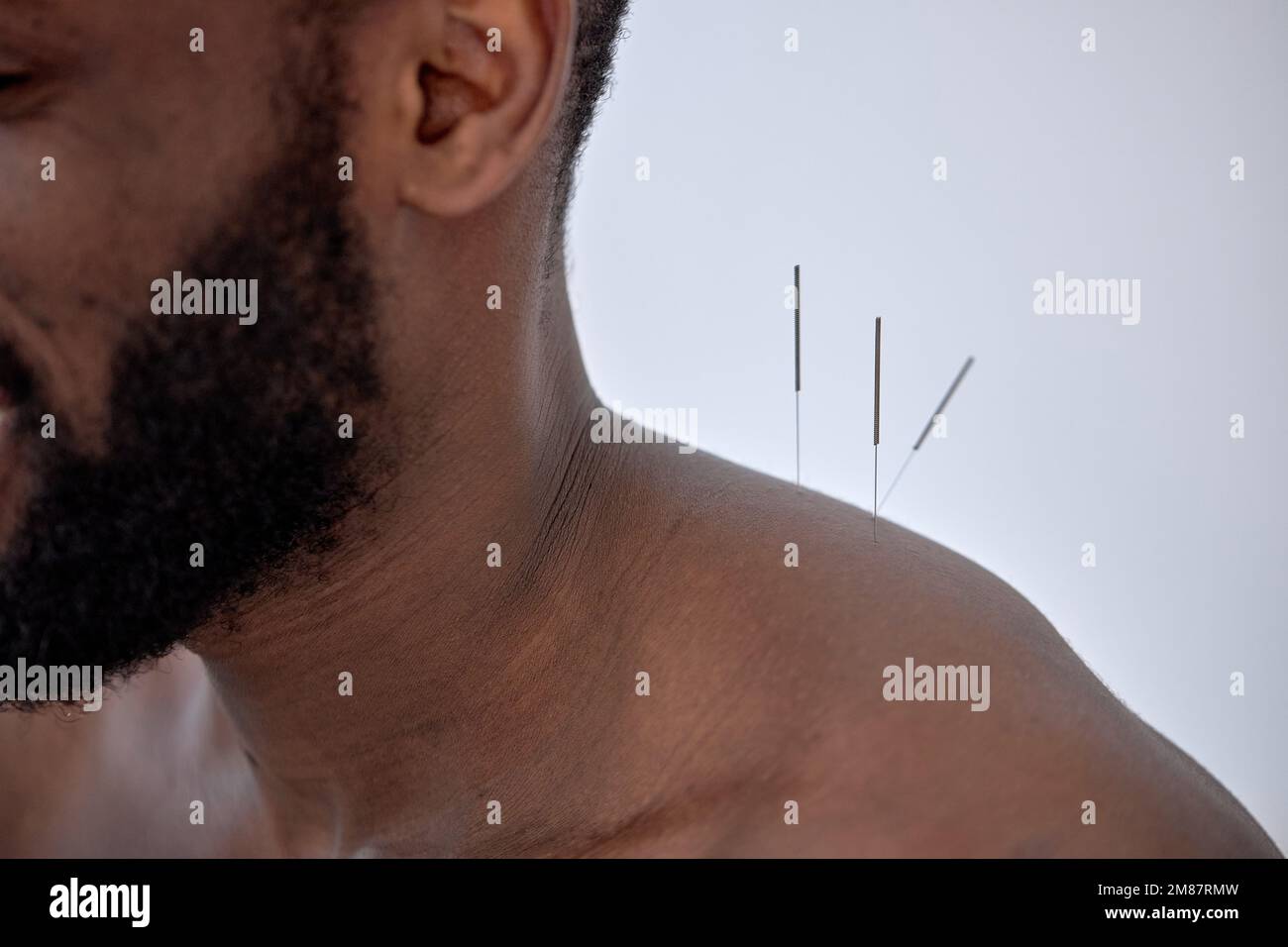 acupuncture therapy on back spine shoulders for black client. cropped