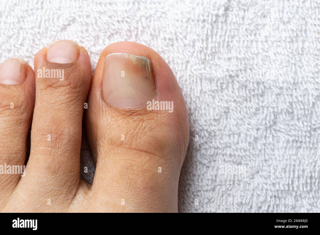 High angle shot of finger with nail fungus infection on a white towel Stock Photo