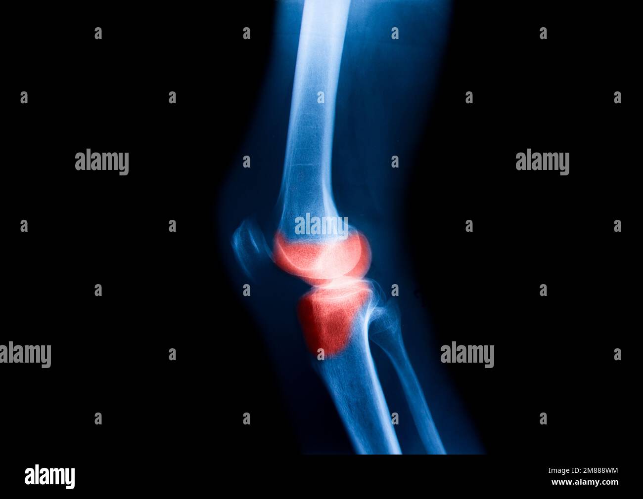 Knee osteoarthritis xray hires stock photography and images Alamy