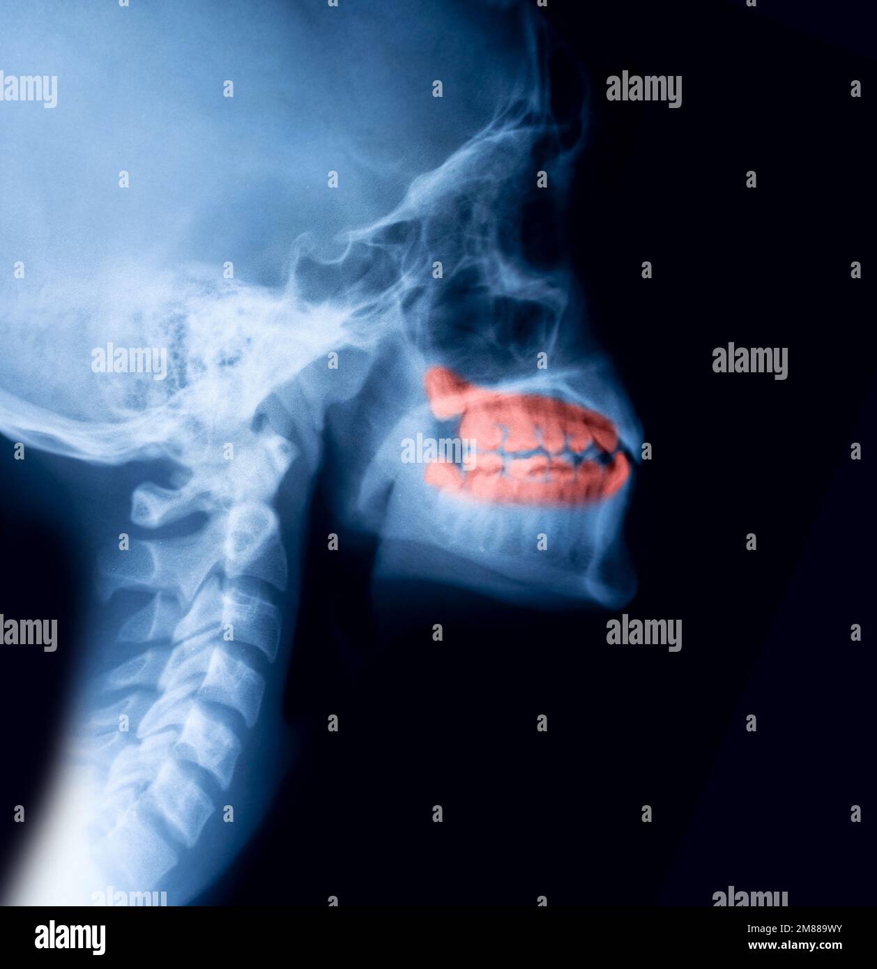 Decayed Tooth Pain On XRay Stock Photo Alamy