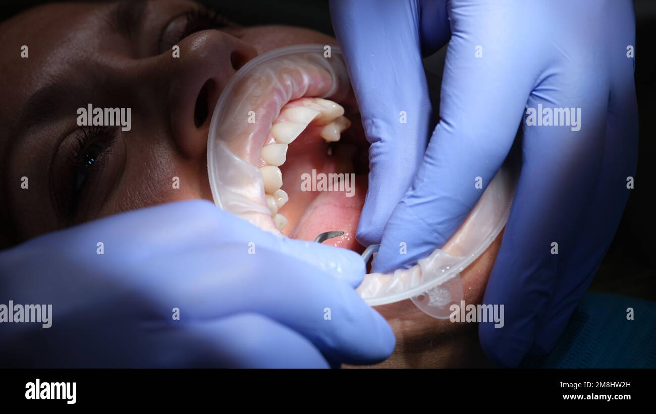 Dentist prepares female teeth for installation of ceramic veneers and