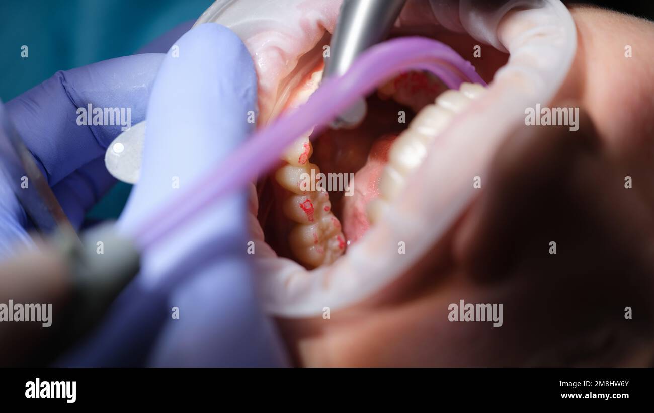 Dentist prepares woman teeth for installation of ceramic veneers and